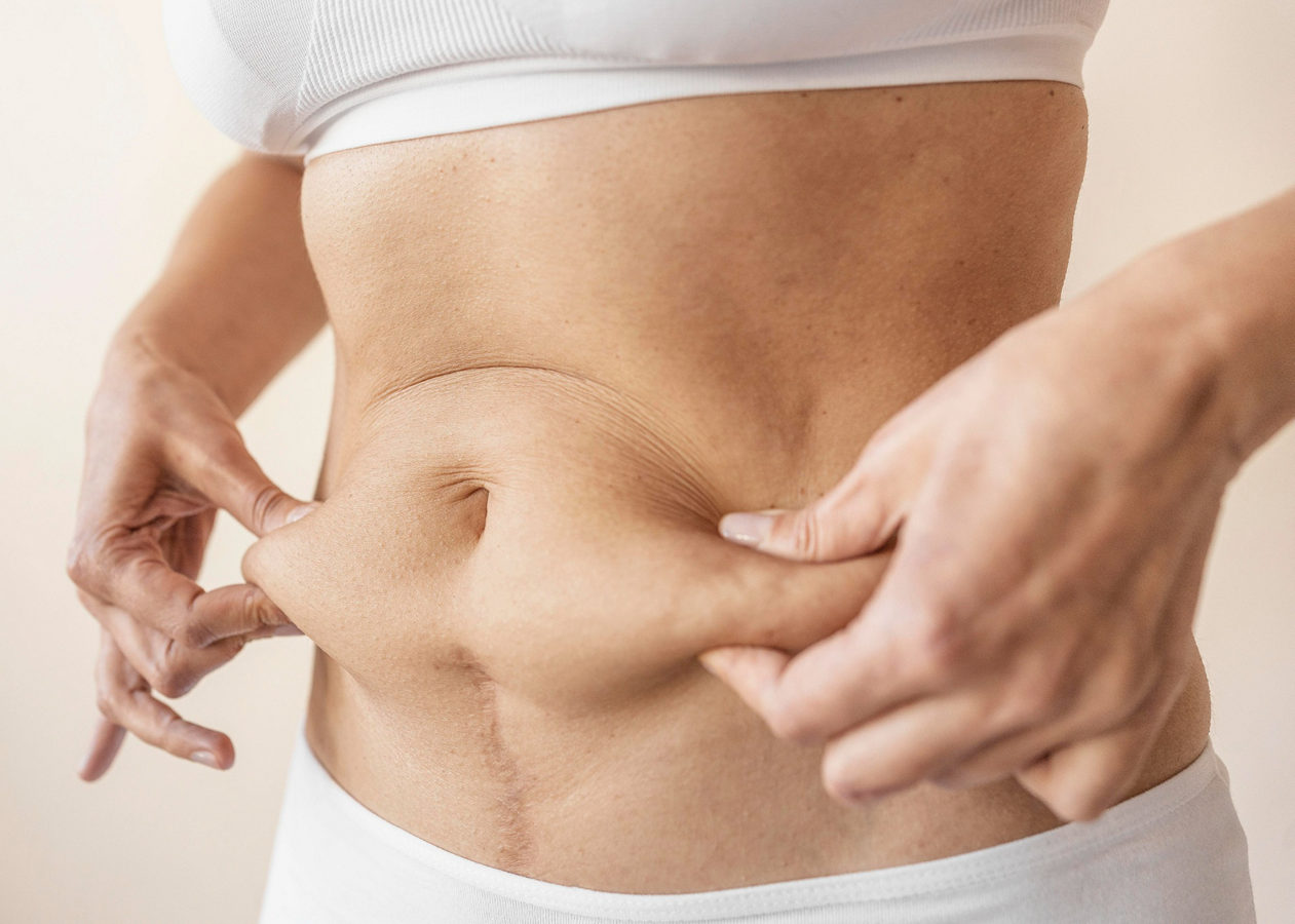 Alles over liposuctie en lipoedeem: info, opties, herstel